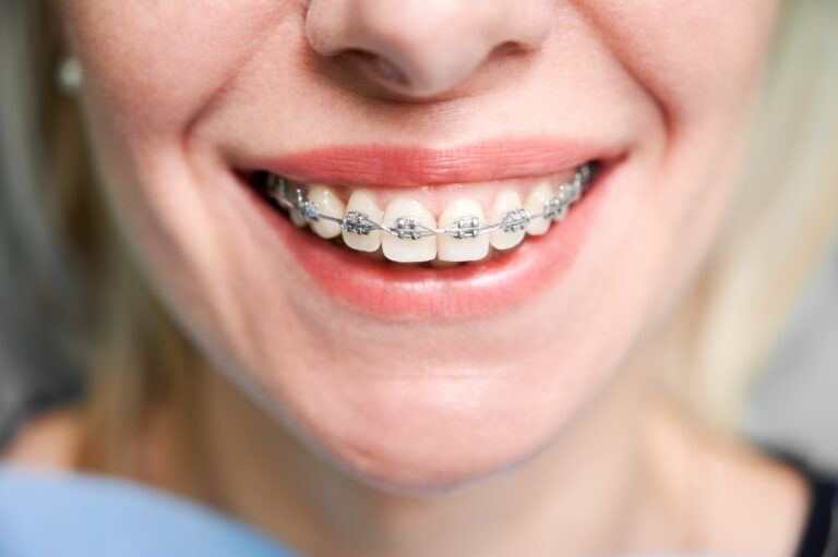 a girl smiling with diamond braces